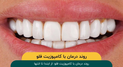 روند-درمان-با-کامپوزیت-فلو-از-ابتدا-تا-انتها